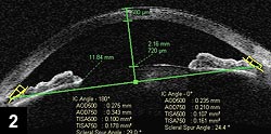 Figure 2: Evaluation after iridotomy of the patient in Figure 1, showing greater opening of the angle and flattening of the posterior pigmented iris line