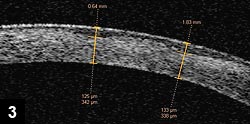 Figure 3: Corneal scar showing loss of corneal tissue and epithelium filling