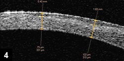 Figure 4: Corneal scar of the patient in Figure 3 after PRK.