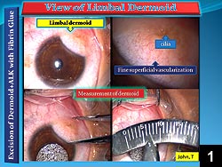 Figure 1: Intraoperative, low-power view of a limbal dermoid located in the inferior temporal quadrant of the limbus and extending into the peripheral cornea 