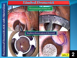 Figure 2: Horizontal measurement of the limbal dermoid using Castroviejo calipers measures 7.75 mm