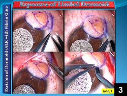 Figure 3: Conjunctival exposure of the limbal dermoid