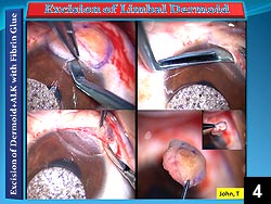 Figure 4: Lamellar dissection of the limbal dermoid