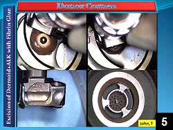 Figure 5: Donor cornea is encased within the Moria automated anterior lamellar keratoplasty system and an automated Moria CB-microkeratome is used to prepare the donor lamellar graft