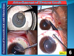 Figure 6: Donor corneal lamellar graft is placed on the ocular surface in the region where the dermoid was excised