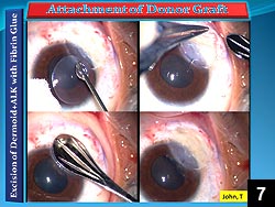 Figure 7: Application of the fibrin glue, component 2, to the donor lamellar graft