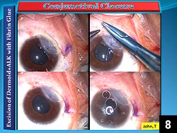 Figure 8: Conjunctival closure