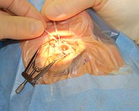 Two large bore, thin-walled self-retaining anterior chamber maintainers are introduced in the inferior quadrants