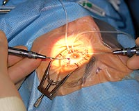 This shows placement of the cannulas inferiorly at the limbus and stabilized in the corneal 1-mm diamond knife paracentesis openings to the anterior chamber