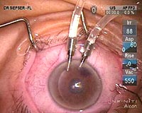 This image illustrates the final position of the graft prior to air injection and removal of the chamber maintainers