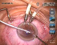 This operating microscope view shows the left hand introducing the graft into the anterior chamber through a 3-mm incision