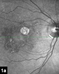 Figure 1a: Fluorescein angiogram demonstrating a patchy hyperfluorescent and hypofluorescent pattern bilaterally consistent with retinal pigment epithelial atrophy in pattern dystrophy