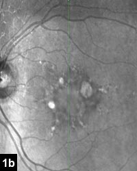 Figure 1b: Fluorescein angiogram demonstrating a patchy hyperfluorescent and hypofluorescent pattern bilaterally consistent with retinal pigment epithelial atrophy in pattern dystrophy