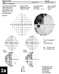 Figure 2a: Humphrey visual field of the left eye showing a superior temporal defect