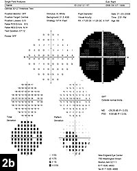 Figure 2b: Humphrey visual field of the right eye showing a dense central defect