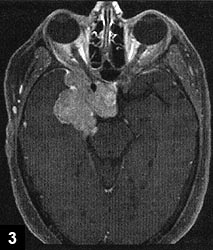 Figure 3: Large enhancing mass involving the right orbital apex and right cavernous sinus extending to the sella