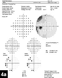 Figure 4a: Humphrey visual field of the left eye showing improvement of the superior temporal defect at the 2-month postop visit