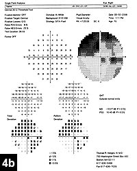 Figure 4b: Humphrey visual field of the right eye showing improvement of the dense central defect at the 2-month postop visit