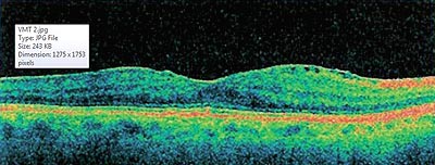 During the course of preop testing that Dr. Trattler performs for best postop results, he learned that this cataract patient had an epiretinal membrane and was at an increased risk of developing cystoid macular edema after surgery