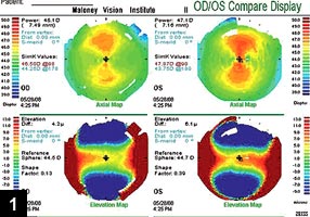 Figure 1: Corneal topography shows significant corneal astigmatism in both eyes of this highly myopic patient