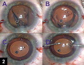 Figure 2: The leading corners of the ICL are placed under the nasal iris using just the inserter system