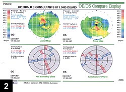 Figure 2: Topography of a patient complaining of glare, halo and decreased visual acuity