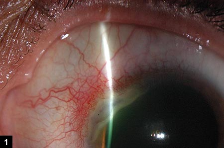 Figure 1: Color photo of the left eye shows sectoral conjunctival injection with a superonasal peripheral corneal lesion