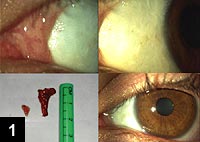 Figure 1: High magnification image of pterygium area at medial canthus (note cut end of remnant stump) postop (top left)