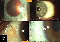 Figure 2: Preop image of pterygium (top left)