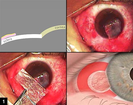 Figure 1: Schematic representation displaying the bare sclera after pterygium excision