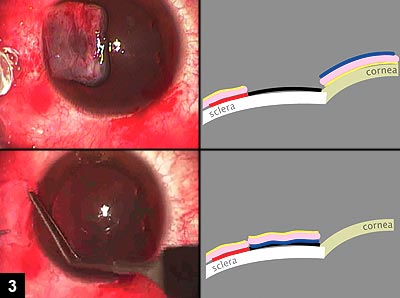 Figure 3: Thrombin (black label vial) diluted with balanced salt solution is placed on the excision site, and fibrinogen (blue label vial) is placed on the stromal side of the autograft