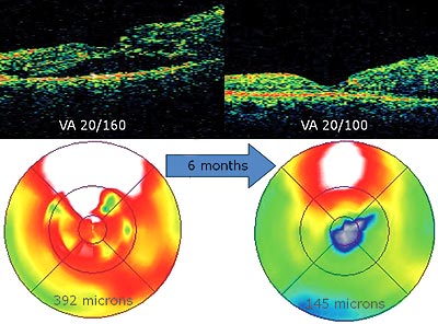 OCT diagrams showing changes in foveal thickness in a patient with significant diabetic macular edema before (OS) and after (OD) intravitreal triamcinolone injection