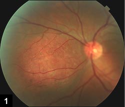 Figure 1: Elevated reddish-orange mass nasal to optic disc in the left eye with retinal pigment epithelium hyperplasia and fine retinal telangiectasias on the surface