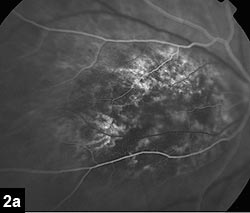 Figure 2a: Fluorescein angiography showing early filling of mass during choroidal phase with mottled hyperfluorescence