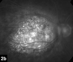 Figure 2b: Later frames with more confluent hyperfluorescence and late leakage