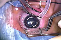 Image shows pars plicata vitrectomy with 25-gauge instrumentation in a pediatric eye