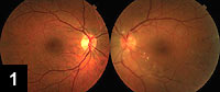 Figure 1: Right and left color fundus photographs