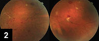 Figure 2: Left color peripheral fundus photographs showing focal vasculitis along retinal veins