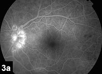 Figure 3a: Fluorescein angiogram, left eye