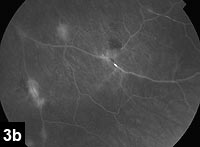 Figure 3b: Fluorescein angiogram, left eye