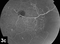 Figure 3c: Fluorescein angiogram, left eye. Peripheral retinal capillary non-perfusion