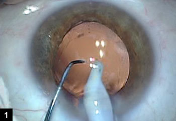 Figure 1: With a toric IOL in the capsular bag, the chopper is used to hold the IOL securely in correct alignment while the irrigation and aspiration probe is used to remove viscoelastic from the anterior chamber