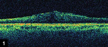 Figure 1: Moderate cystoid macular edema