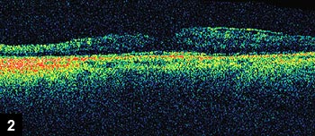 Figure 2: Moderate cystoid macular edema