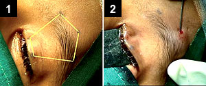 Figures 1 and 2: Jacob-Agarwal technique of guided sling surgery