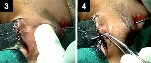 Figures 3 and 4: On reaching the corner of the pentagon, instead of bringing the needle out through an incision, its direction is changed and it is passed downward and guided using a combination of visualization and palpation along the lower limb of the pentagon toward the lid margin mark
