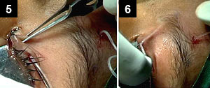 Figures 5 and 6: It is then reinserted through the same needle prick exit point and passed through the superficial tarsal tissues to emerge through a needle prick exit on the other lid margin mark