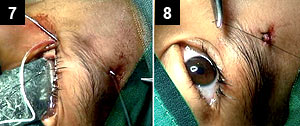  Figures 7 and 8: On reaching here, the direction of the needle is changed while maintaining the surgical plane, and it is guided out of the central suprabrow incision without exteriorizing it anywhere along its path