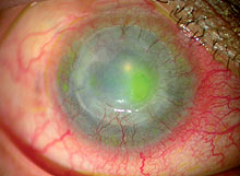 Slit lamp photomicrograph of a patient with two failed corneal transplants and persistent corneal epithelial defect secondary to corneal limbal stem cell deficiency