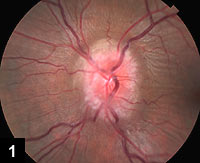 Figure 1: Left optic nerve edema